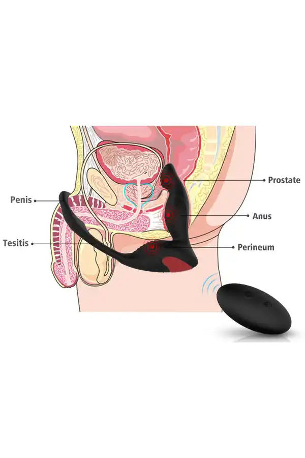 Anal Teknolojik Uzaktan Kumandalı Prostat Aleti